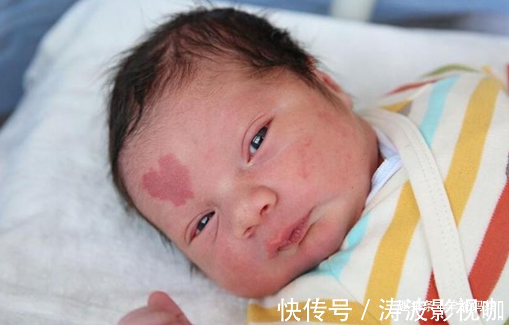 胎儿|越来越多胎儿被“胎记”缠身,若不想孩子自卑,孕妈要管住自己