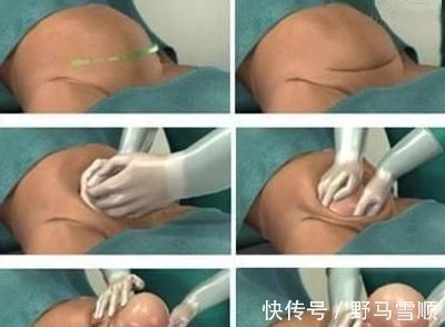 手术|第二次剖腹产真比第一次更疼?这里有标准答案,孕妈早知道早放心