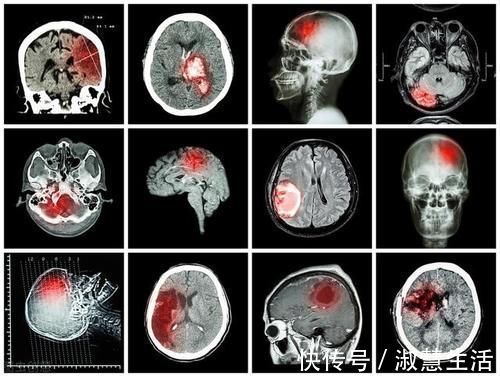 血脂异常|老年人高血脂危害大,世界权威医学杂志:70岁开始降脂也不算晚