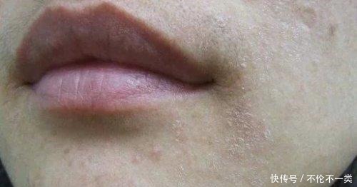 痘痘|刚把脸打湿就用洗面奶难怪痘痘黑头总是找上你!