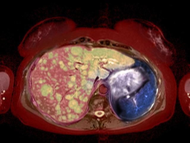 小里|23岁女大学生肝癌晚期,生命最后的愿望竟然是种一棵树