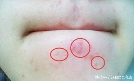 肝解毒能力下降,脸上有“呼救”,若出现,提