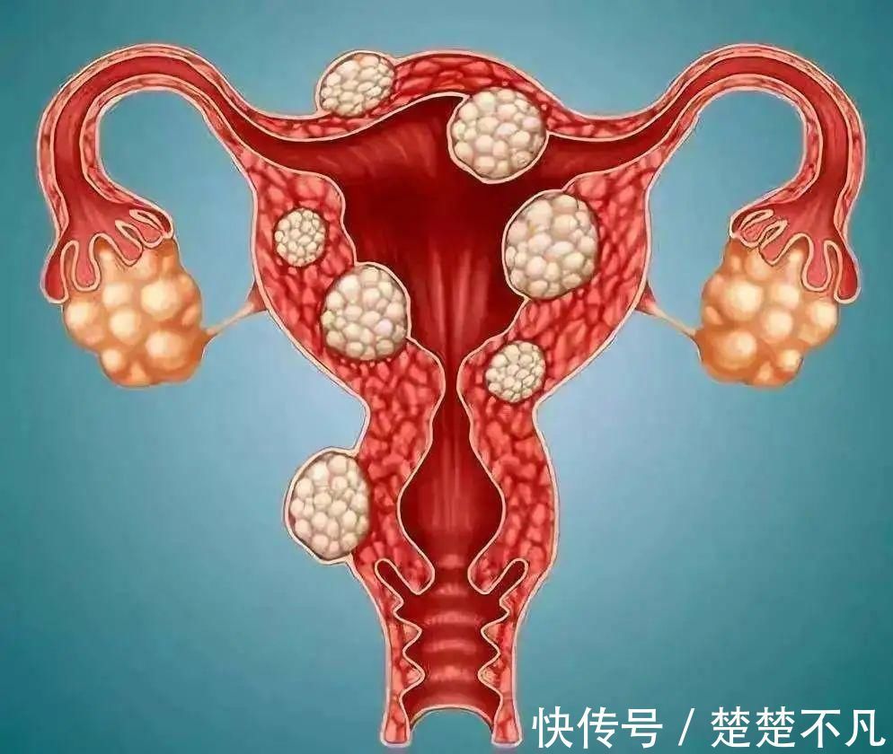 盆腔积液|5分钟教你看懂妇科体检报告单!有些病可能是唬人的“纸老虎”!