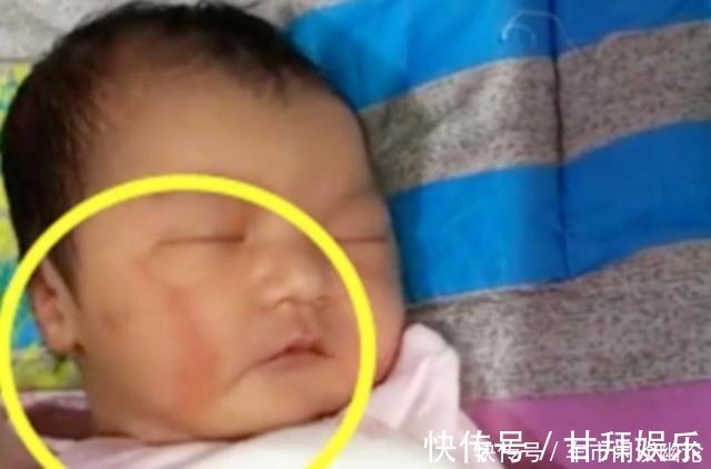 恢复期|剖腹产划伤宝宝脸颊,医生安慰“问题不大”,2个月后父母找说法