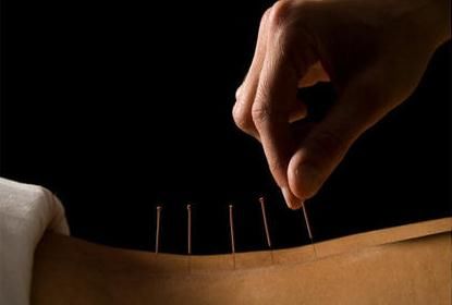 意外|阿婆自行针灸出意外，5厘米断针留在腹中