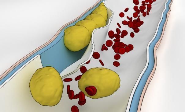 木耳|“溶栓高手”找到了,不是木耳,没事敞开喝,血栓悄悄地不见了
