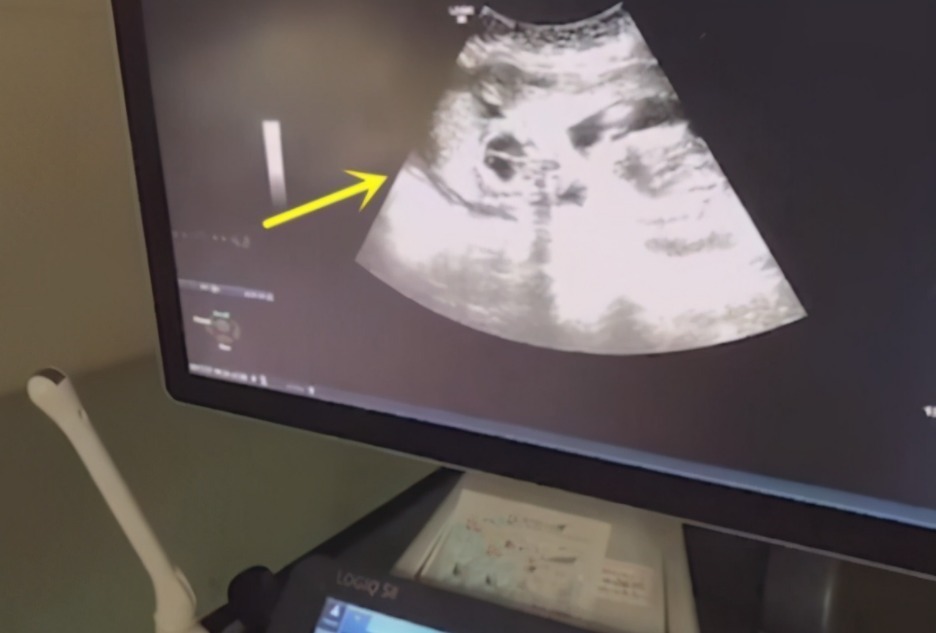 大宝|10岁男孩哭求妈妈生二胎,逢产检比爸爸还积极,亲自看结果才放心