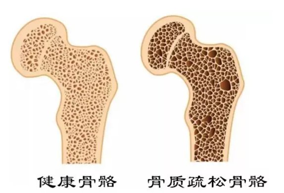 骨质疏松了？可能也有冠心病！|【健哥说心脏】世界骨质疏松日| 骨量