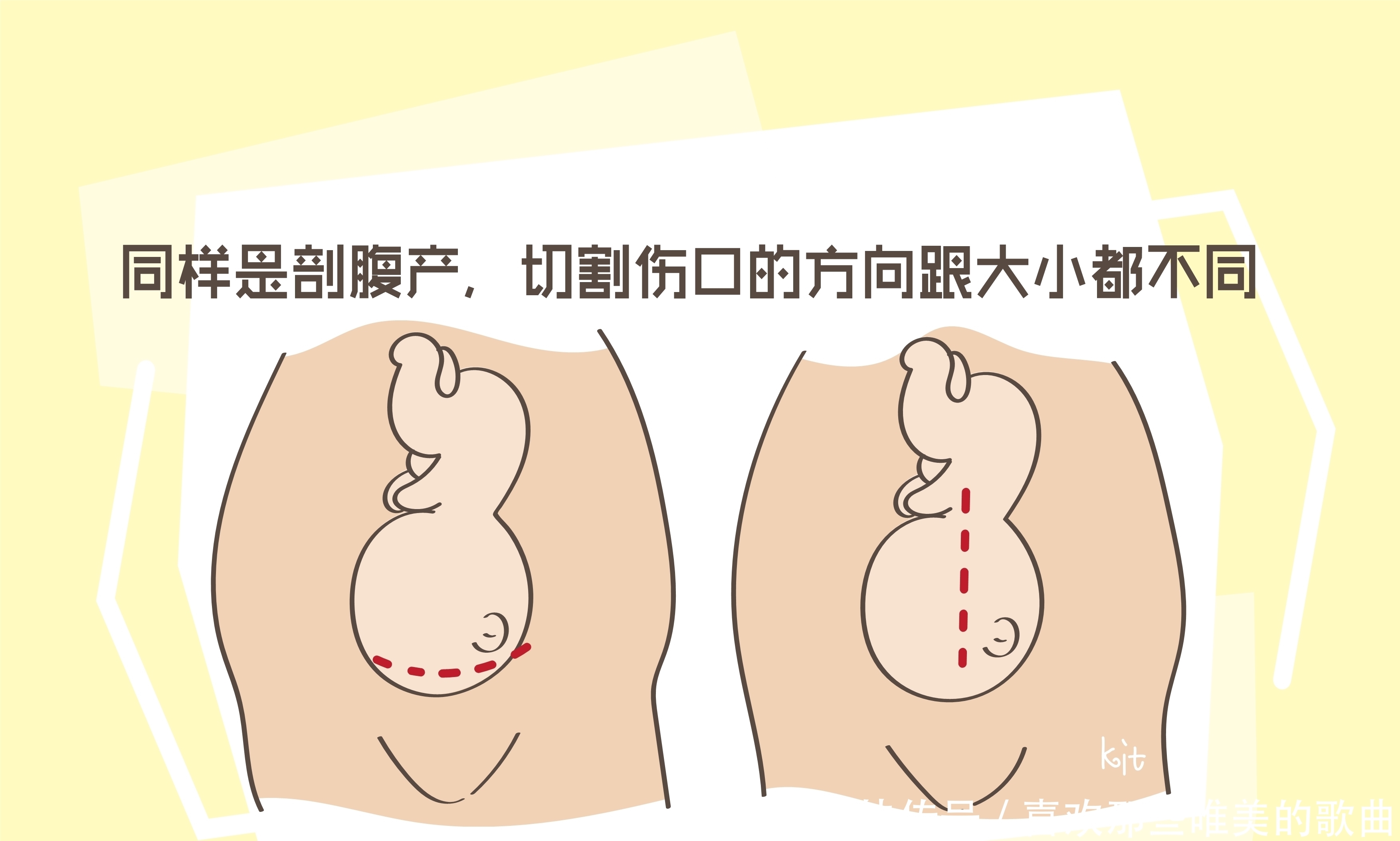 选择|不能顺产只能选择剖腹产，是竖切还是横切要多多考虑