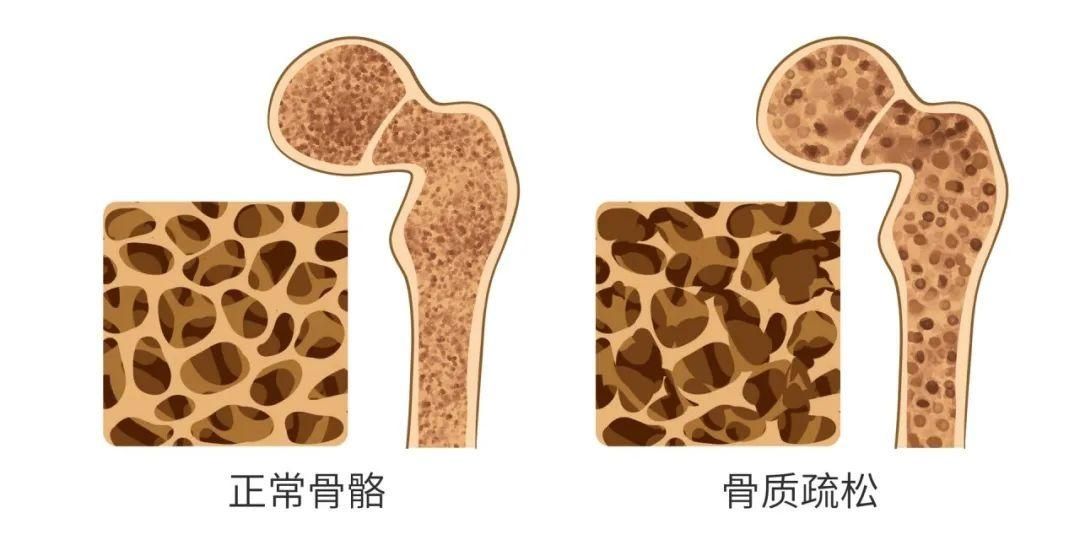  人缺钙|【健康】给“口重”的人提个醒：你可能已经在“骨质疏松”的边缘了