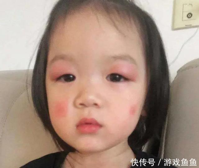 花露水|宝宝被蚊子咬成“大耳朵图图”,又疼又痒还留疤,怎么处理最好?