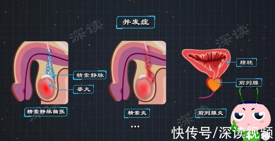 蛋蛋|蛋蛋又痛又肿还发烧？小伙长期熬夜突发睾丸炎？这些症状要小心