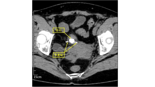 20多年前“迷失”的节育环，竟然“长出了”膀胱结石……