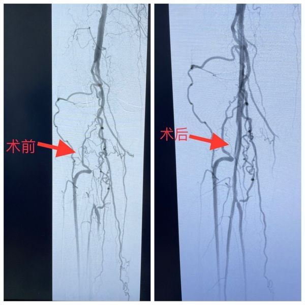 血管狭窄|多年腿疼误以为是关节炎，老人走不动路才知是＂腿梗＂险截肢