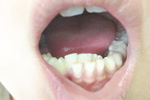 颌骨|宝宝长出吓人的双排牙,只因宝妈准备饮食时,多做了一件事