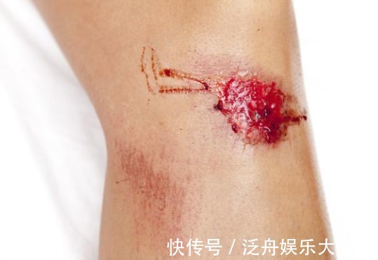 肝脂|37岁女子,满脸黄褐斑,竟查出肝炎,提醒5个表现或是肝病前兆