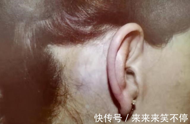 无痕 “大拉皮手术”后又美又无痕,医生是要费些心思的!