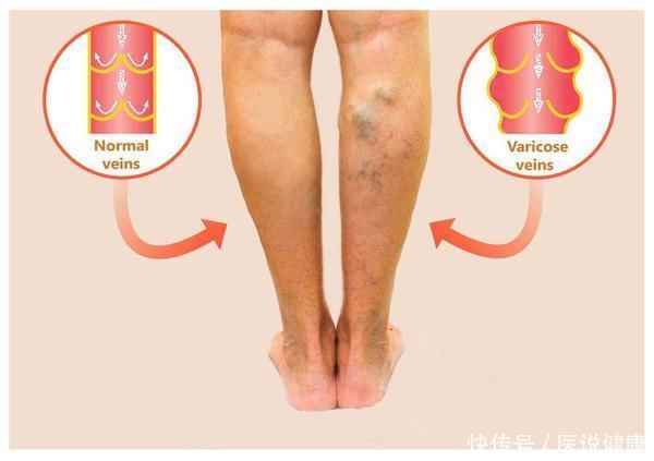 信号|血栓近身的5个信号,若占两个以上,建议你尽快去检查,别拖!