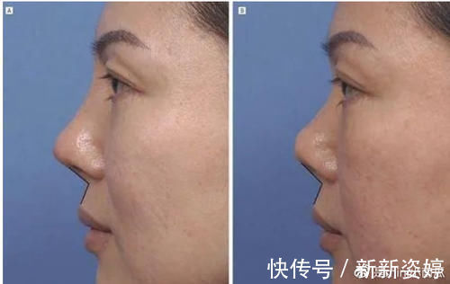 假体|为什么你做的隆鼻没达到预期效果?吸取教训,这些雷别踩!