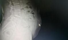 梁阿婆|广州阿婆自行针灸，不料针断腹中！