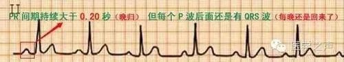 护士这样学心电图，不用死记硬背