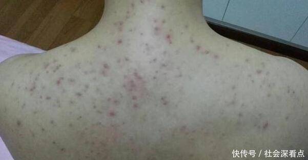 后背经常长黄色“小米粒”一抠一个坑,一个小妙招,荡平后背痘痘