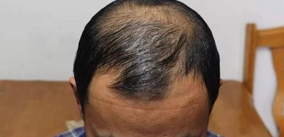  雄激素|当男人开始衰老，身体上会有4种“变化”，若你1个不占，那恭喜了