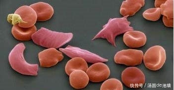 中年|這7種食物真的會加重貧血，別當個單純的吃貨！