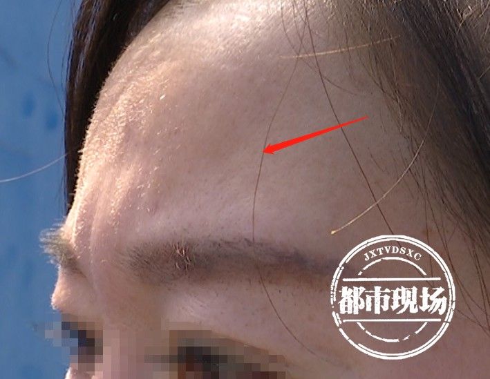 太阳穴 南昌：做这手术后旺夫？女子说结果不是她要的