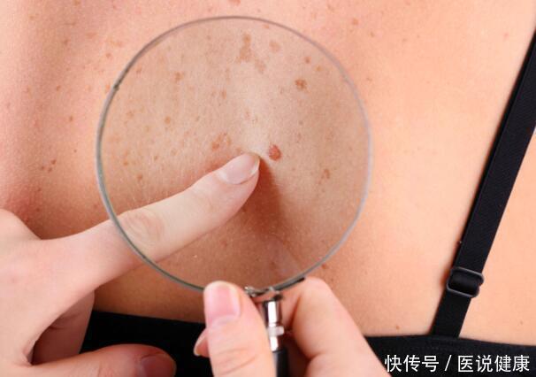 身体出现4个变化，或是肝病来报到了，需留心观察