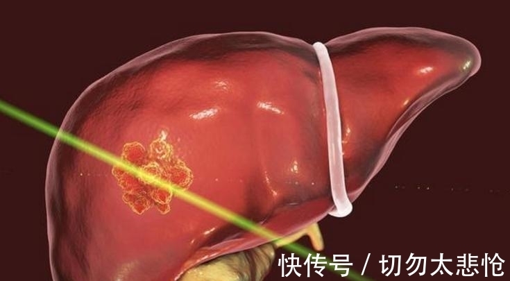 蜘蛛痣|每吃一口近似在肝上打洞，院士呼吁：1“下酒菜”，或比肥肉还伤肝