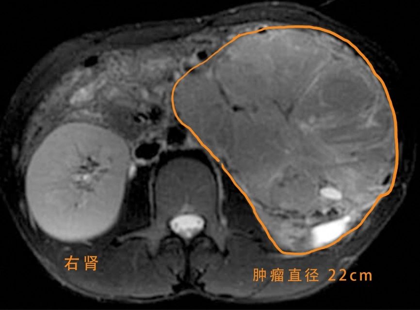 肿瘤|北京同仁医院泌尿外科成功救治罕见巨大肿瘤患者