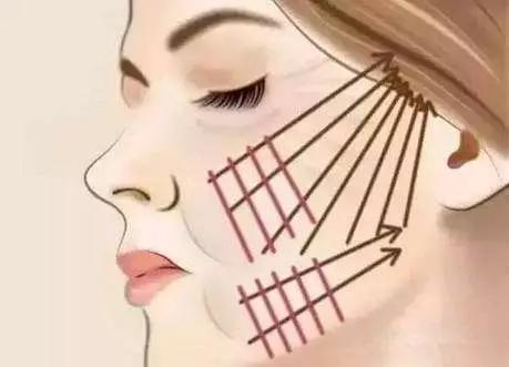 埋线|埋线提升不仅能让你年轻10岁,还能让你即刻拥有小V脸!