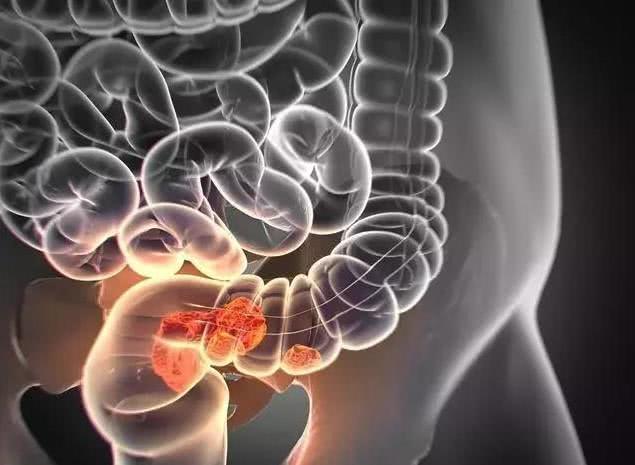 离世|46岁男子肠癌晚期，三月后离世，医生叹气这2件事不能总做！