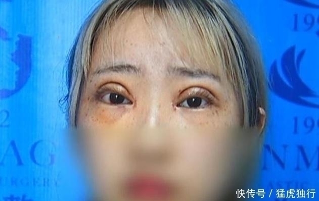 医院|女子双眼皮术后眼睑外翻，要求医院赔偿被拒，网友：屠龙刀割的吧