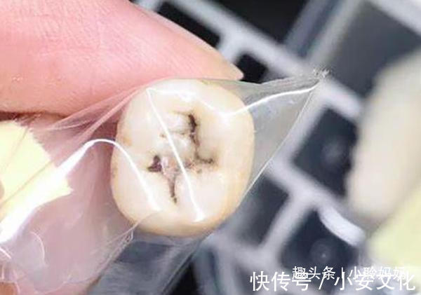 干细胞|孩子乳牙掉了先别扔,关键时候能救命事情可能没你想的那么简单