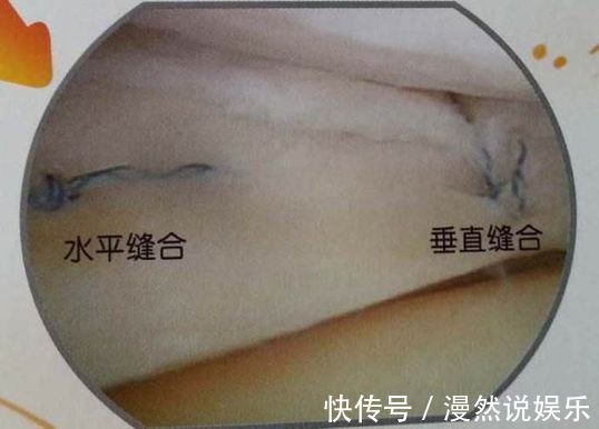 事儿|运动后，你的半月板还好么关于半月板的这点儿事儿！