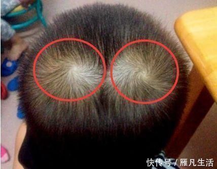 智商|孩子头顶有“2个旋”代表什么?和性格、智商有关吗?家长要清楚