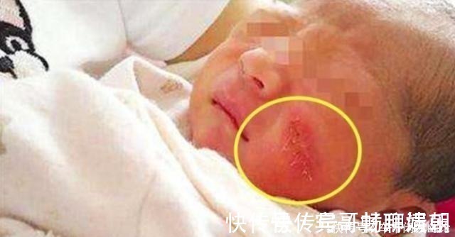 医生|剖腹产划伤宝宝脸颊，医生安慰“问题不大”，2个月后父母找说法