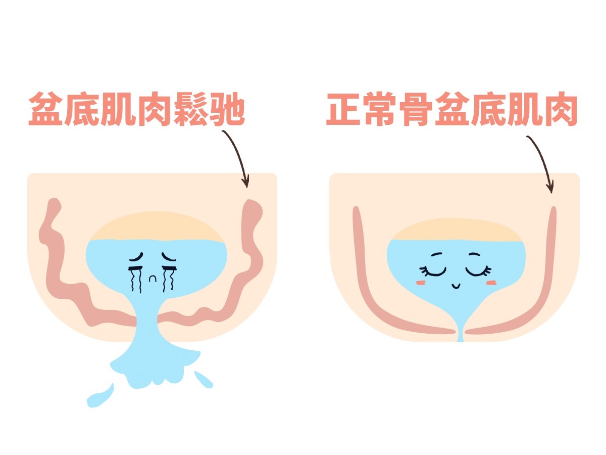 修复|科学正规的盆底肌修复是啥样的?防踩雷必看!