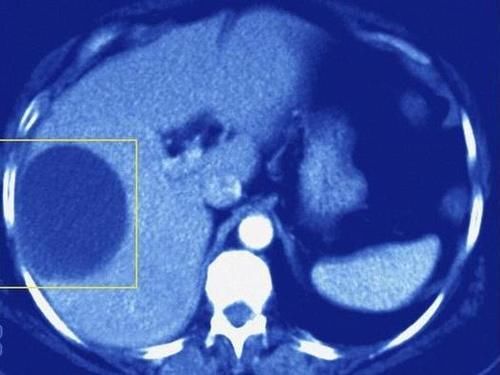 结节|结节、息肉、囊肿、增生，哪个是癌症“先兆”？一文给你说清