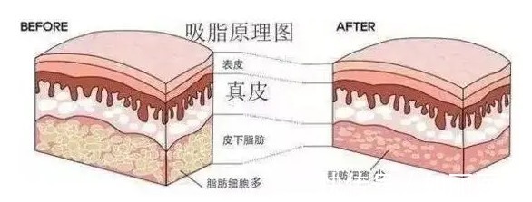 医生 抽脂手术大概花多少钱?附价格表2022一览+危害盘点!