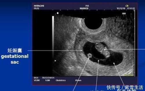 早产儿|总是听说孕妇需要经历怀胎十月,那胎儿一般在多少周会出生呢?