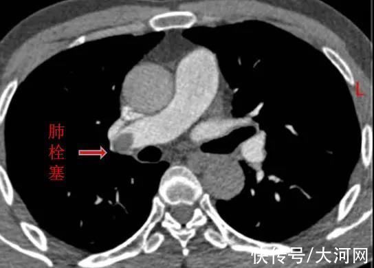 滤器|河南男子腿静脉血栓危及生命 医生：久坐不动是下肢深静脉血栓诱因之一