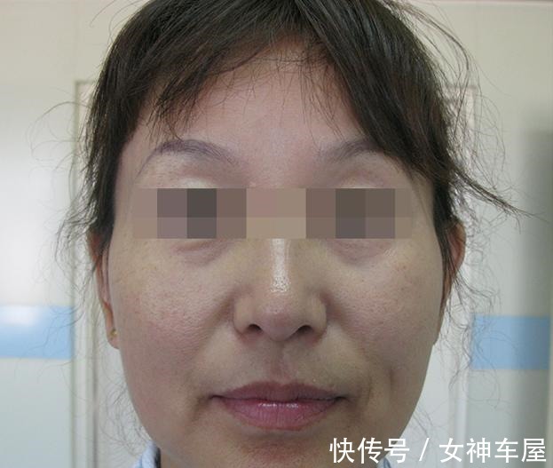 拉皮 46岁做拉皮手术是种什么体验,分享一下我的真实经历!