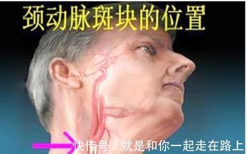 颈动脉|颈动脉有斑块，会有哪些症状？应该如何治疗？医生告诉你答案