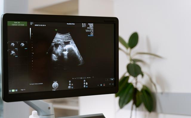 大排畸|大排畸能查出所有的胎儿畸形吗?一次通过大排畸的经验分享给大家