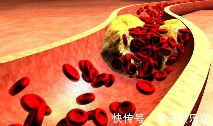 恢复|男子血脂10.8!仅2个月,血脂恢复正常!降血脂冠军是什么