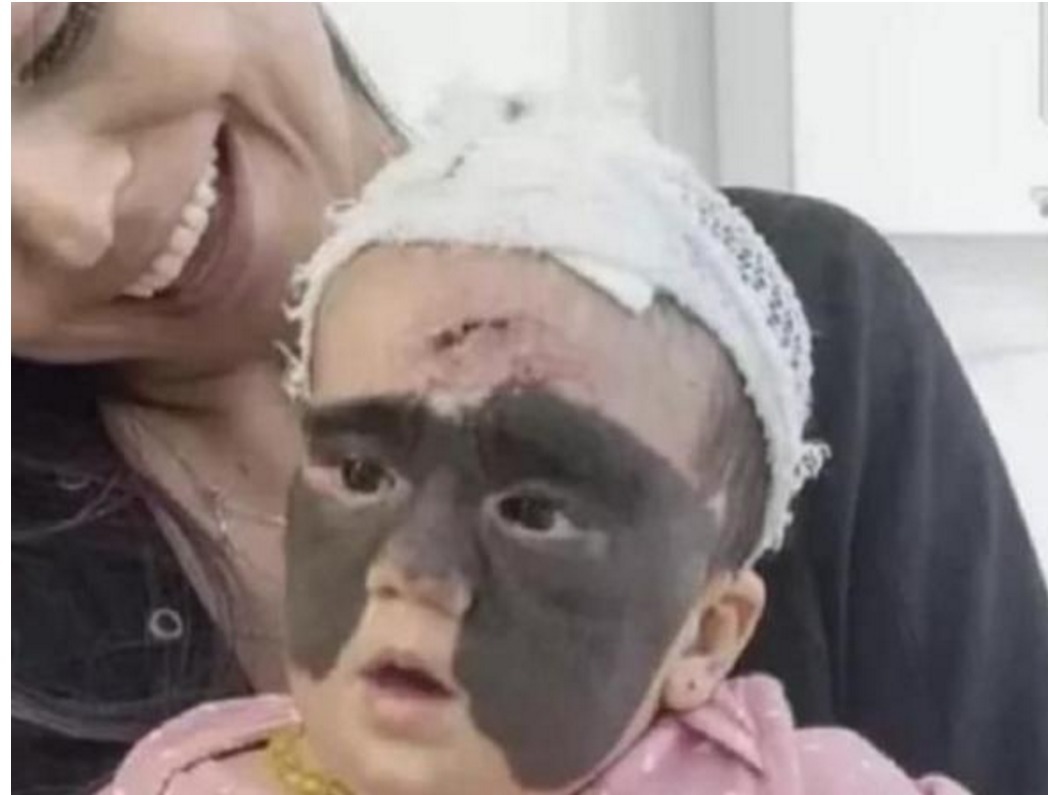 蝙蝠侠|女婴一出生伴随“蝙蝠侠印记”,被父母送去整容7次,结果怎样了