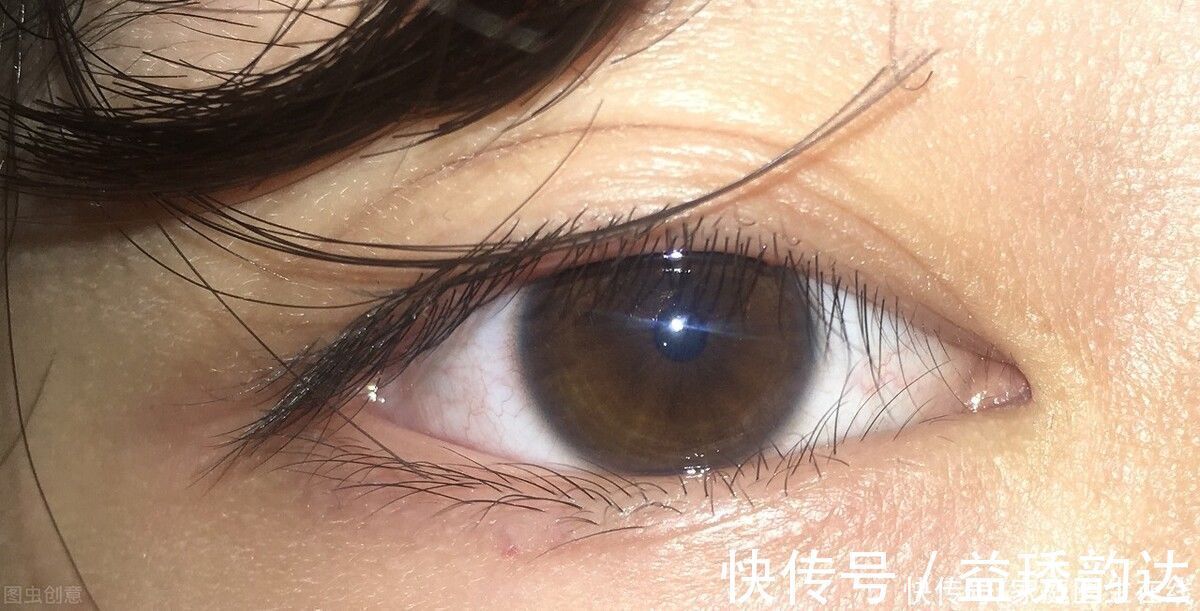 增生|双眼皮手术后疤痕增生是怎么了?做好3件事,可帮你预防